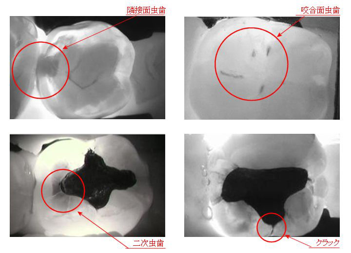 虫歯種類