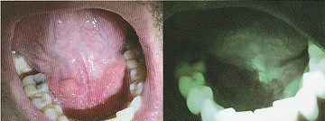 Oral IDでの患部の見え方　細菌感染を伴う形成異常（軽度）